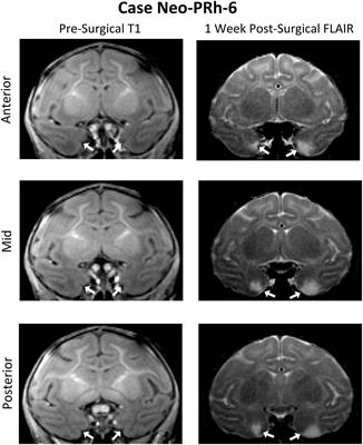 Impaired Cognitive Flexibility After Neonatal Perirhinal Lesions in Rhesus Macaques